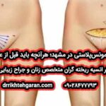 جراحی مونس‌پلاستی در مشهد